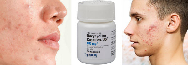 Doxycycline for acne
